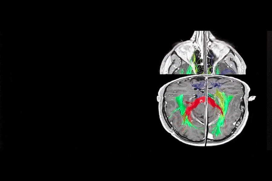 3D PLANNING AND TRACTOGRAPHY (DTI)