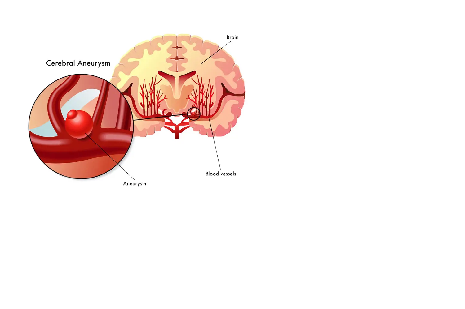 Doctor de Quintana brain surgery Cerebral aneurysms Cerebral malformations Cavernomas