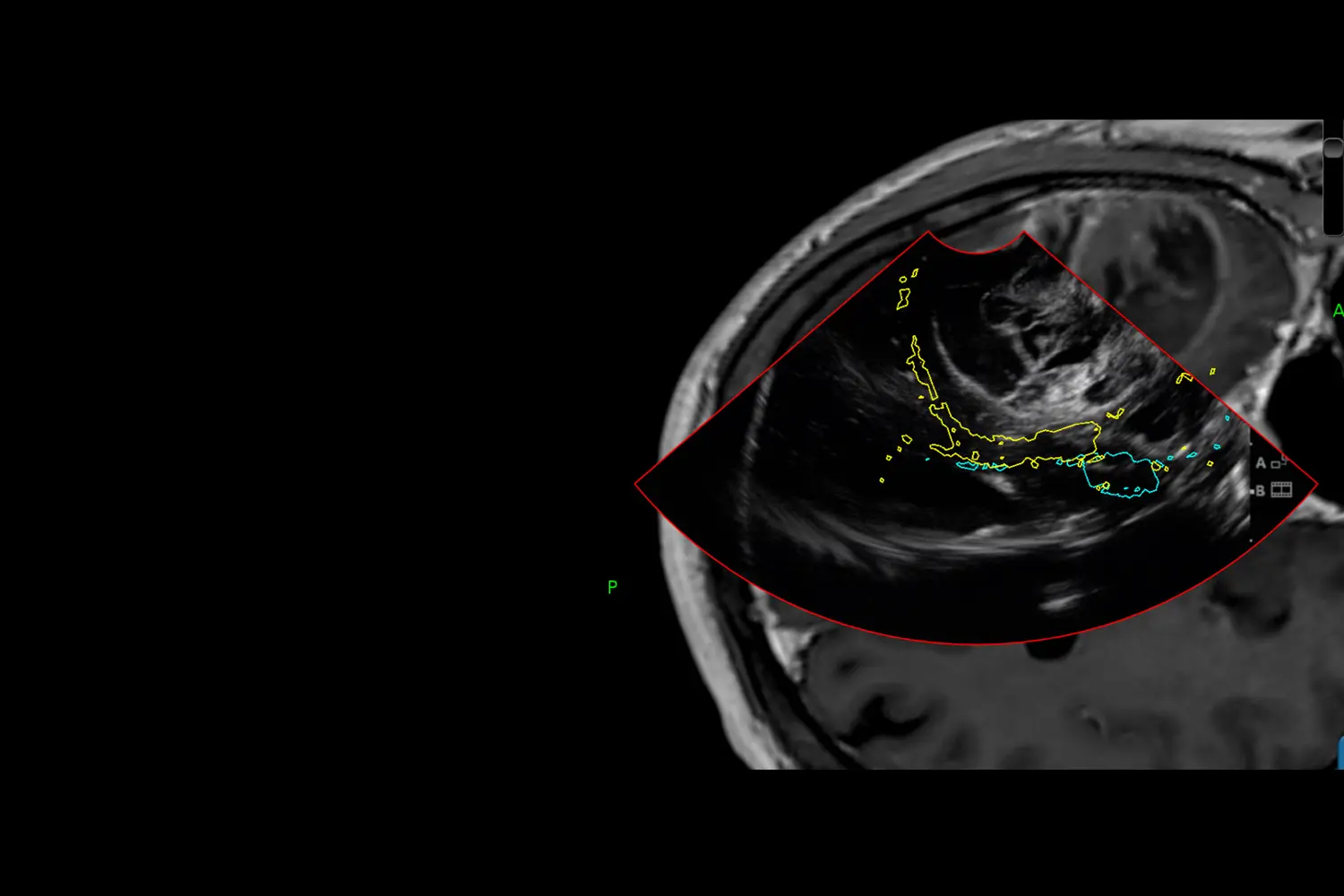 Doctor de Quintana brain surgery navigated brain ultrasound