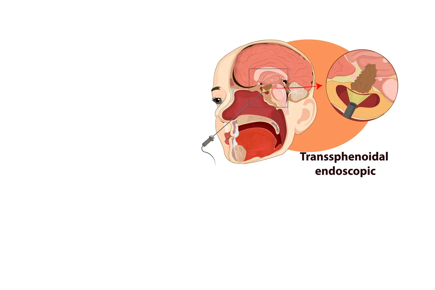 Doctor de Quintana cirurgia cranial endoscòpia cerebral