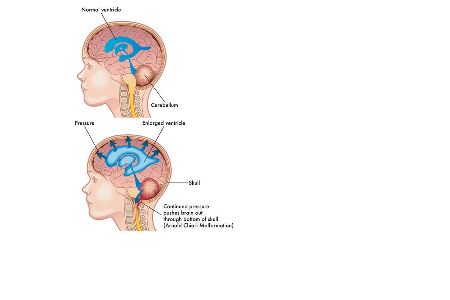 Doctor de Quintana brain surgery hidrocephally craniospinal malformations Chiari