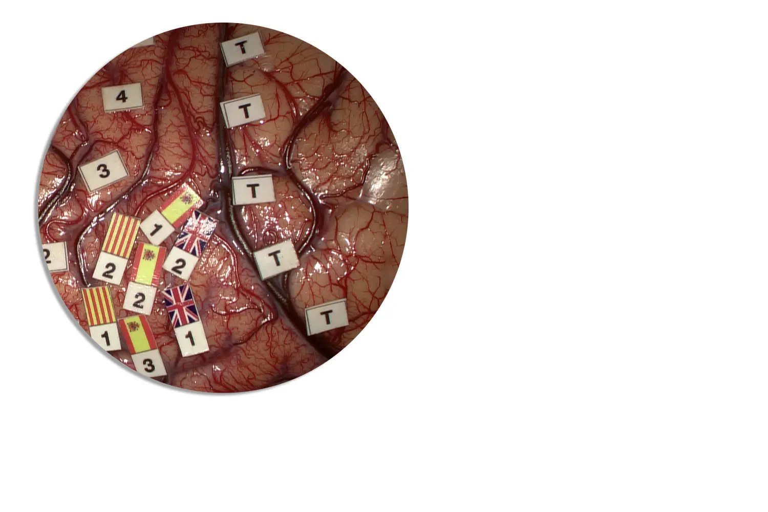 Doctor de Quintana cirugía craneal mapping cerebral