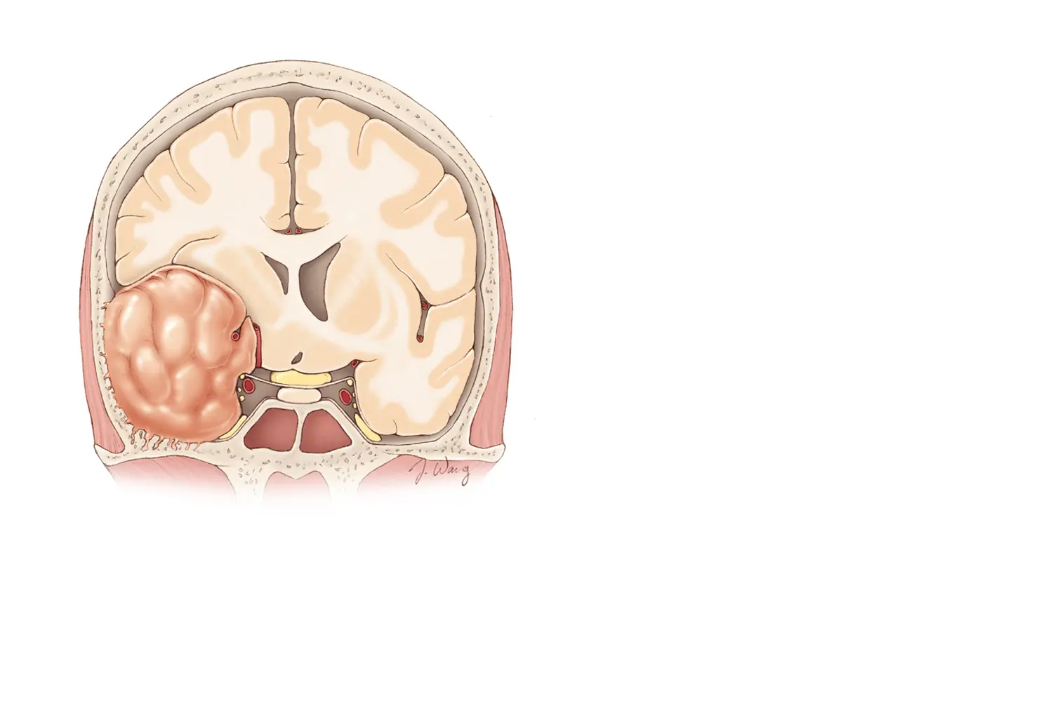 Doctor de Quintana cirugía craneal meningioma neurinoma adenoma