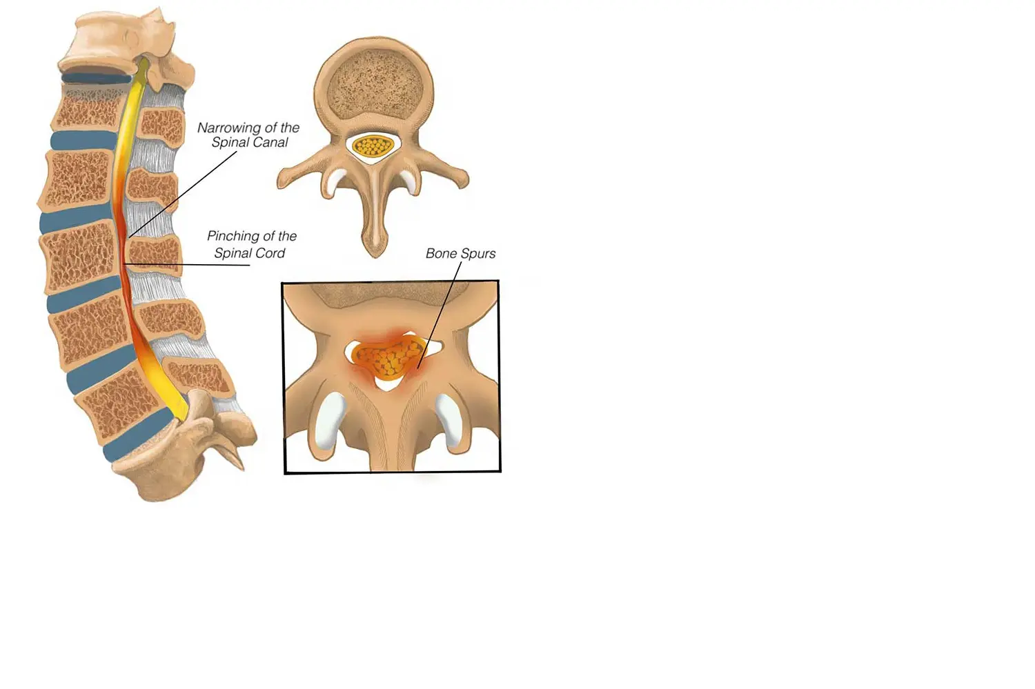Doctor de Quintana cirugía espinal estenosis de canal