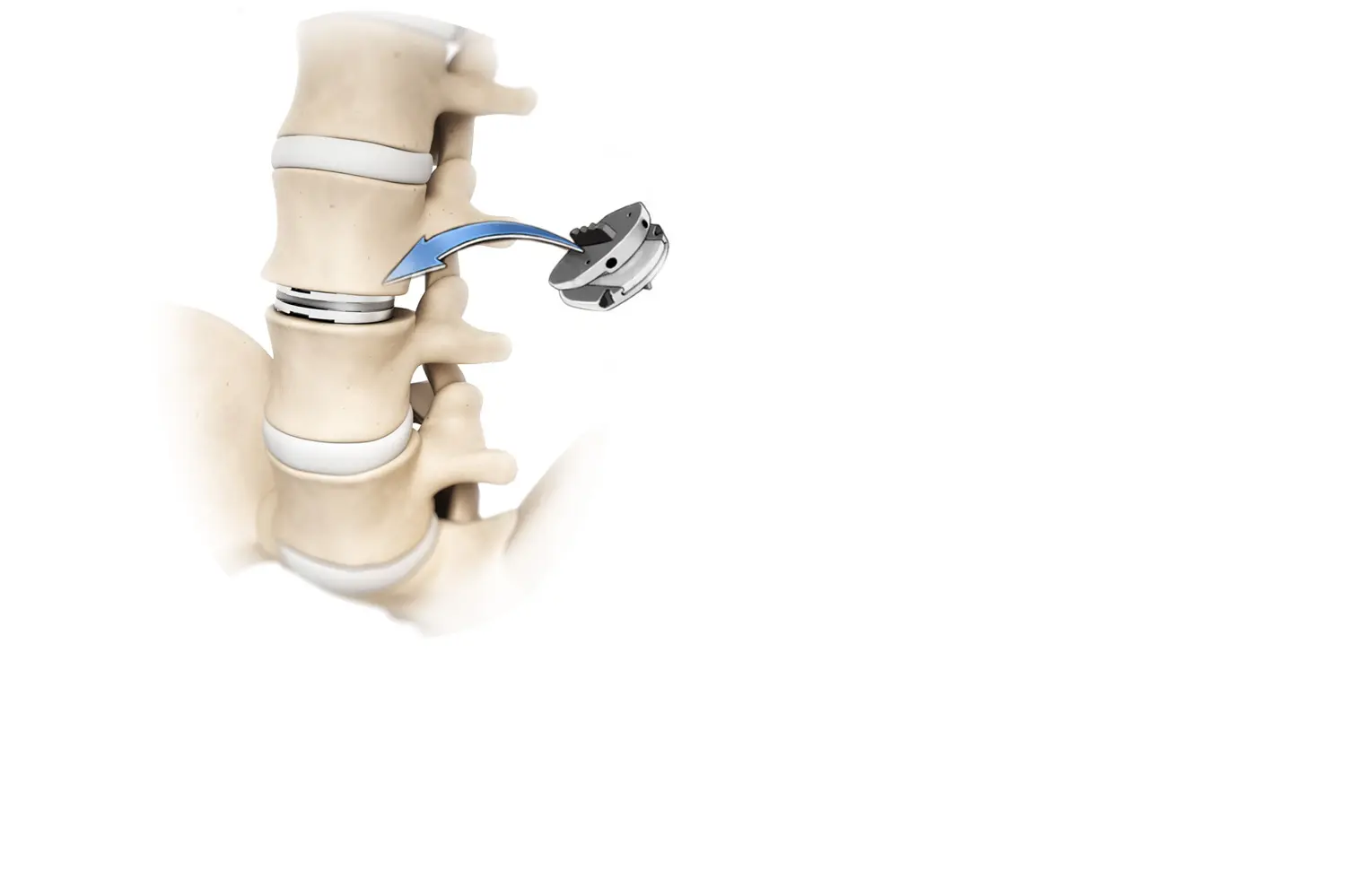 Doctor de Quintana cirugía espinal prótesis de disco