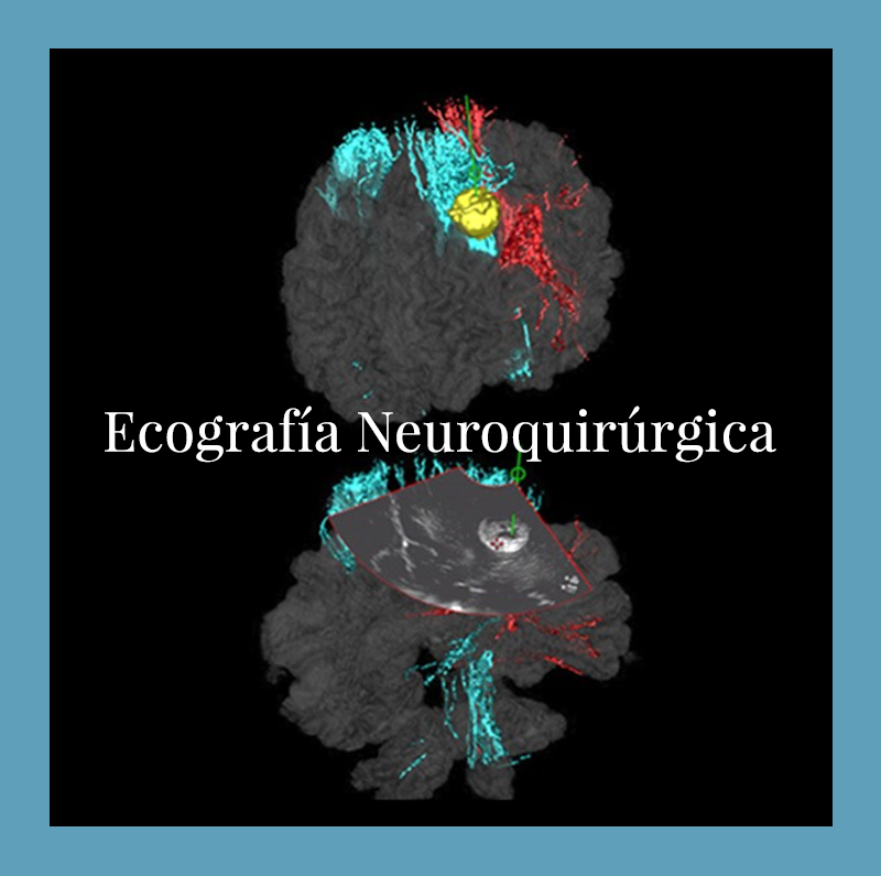 Ecografía neuroquirúrgica