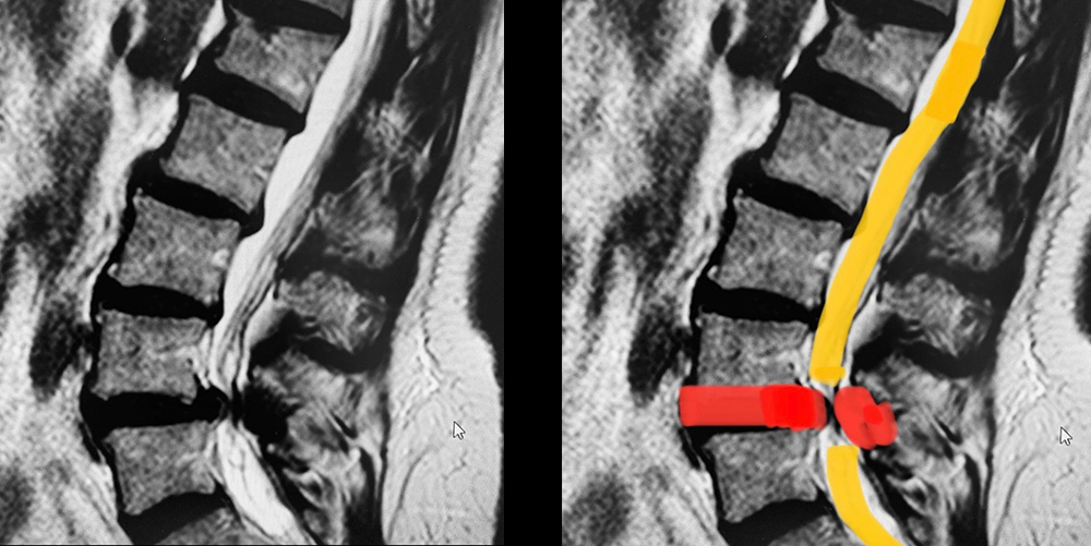 Ejemplo de estenosis de canal donde se observa un
                        estrechamiento del canal por donde pasan los nervios
                        (amarillo) por una protusión discal (rojo anterior)
                        e hipertrofia del ligamento amarillo por artrosis
                        (rojo posterior).